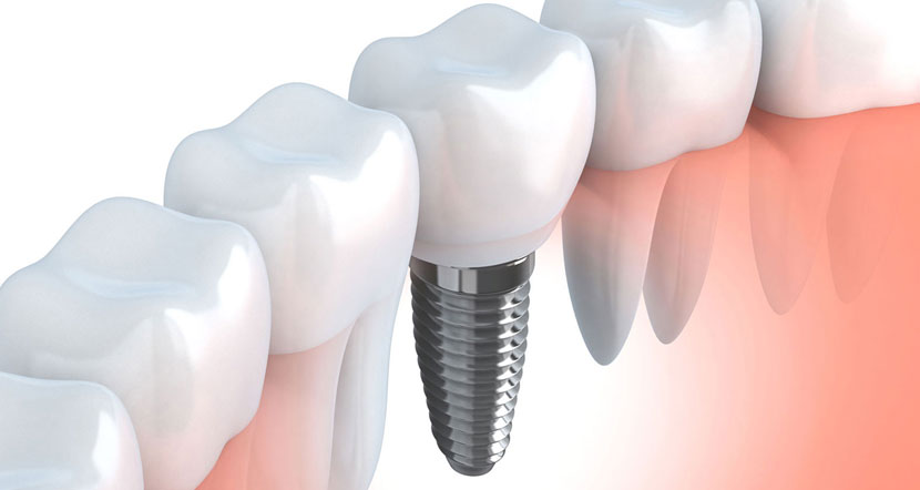implantologia-dentale.jpg